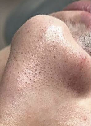 Blackhead removal treatment facial ofy clinics surat raipur nagpur indore bhopal chhindwara best dermatologists in india