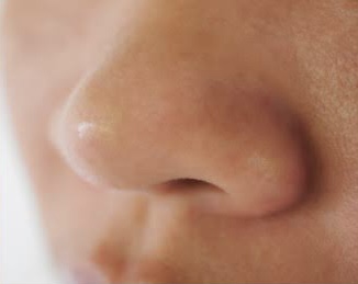 Blackhead removal treatment facial ofy clinics surat raipur nagpur indore bhopal chhindwara best dermatologists(1)