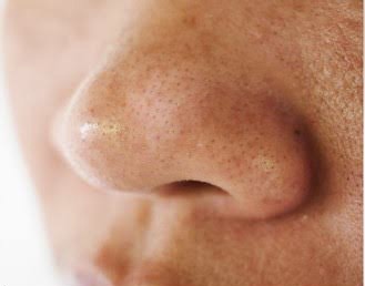 Blackhead removal treatment facial ofy clinics surat raipur nagpur indore bhopal chhindwara best dermatologists