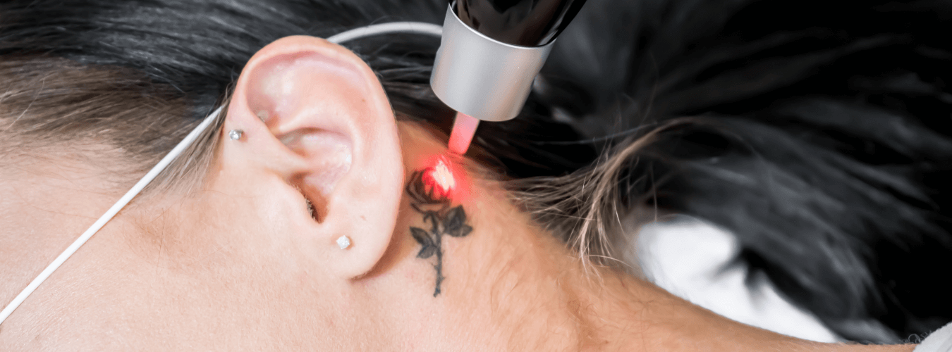 Tattoo removal treatment in surat indore chhindwara bhopal raipur nagpur