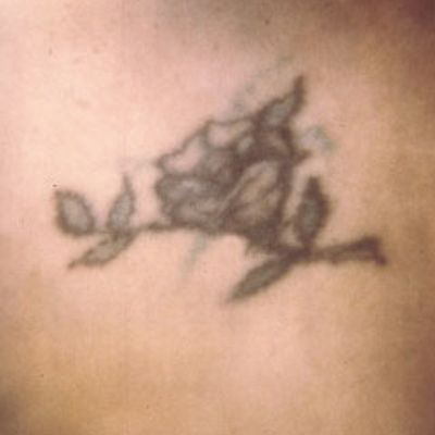 Tattoo removal treatment in surat indore chhindwara bhopal raipur nagpur