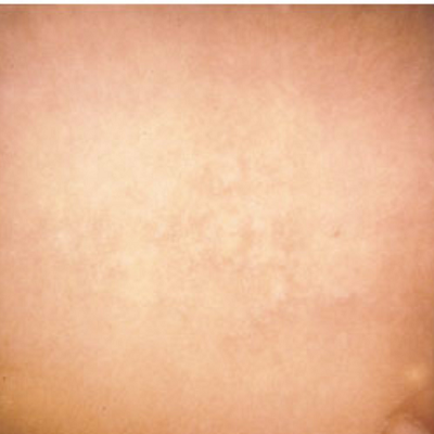 Tattoo removal treatment in surat indore chhindwara bhopal raipur nagpur ofy skin hair body shaping clinics