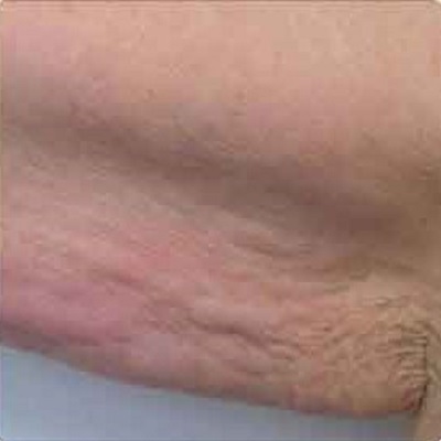 after Body toning treatment fat loss ofy clinics india best deramtologists