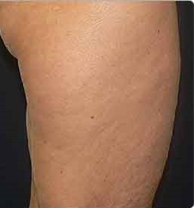 after Body toning treatment fat loss ofy clinics india best deramtologists
