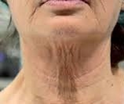 after HIFU High intensity focused ultrasound treatment best skin clinic in chhindwara surat raipur nagpur bhopal