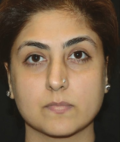 after eye brow lift treatment laser non surgical best dermatologists india ofy clinics before after