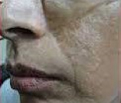 after mole removal treatment surgery painless ofy skin clinics in surat chhindwara raipur nagpur bhopal india
