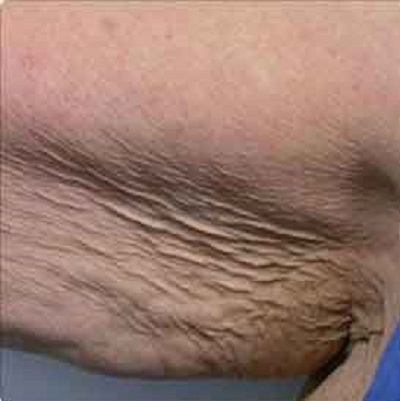 before Bbody toning treatment fat loss ofy clinics india best deramtologists