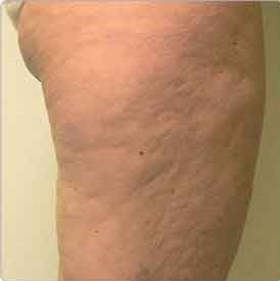 before Body toning treatment fat loss ofy clinics india best deramtologists