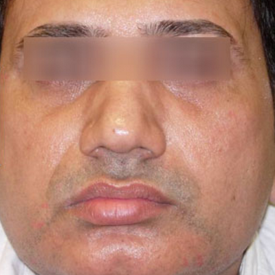 before after anti aging age reversal treatment in surat indore chhindwara bhopal raipur ofy clinics