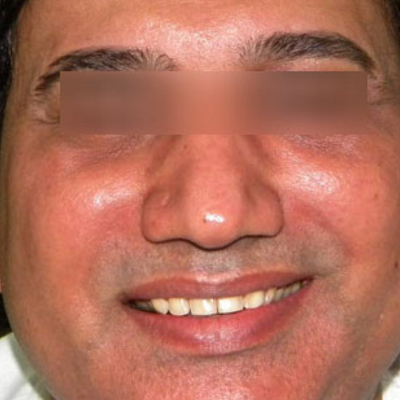 before after anti aging age treatment in surat indore chhindwara bhopal raipur ofy clinics