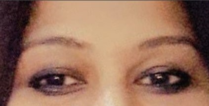 before eye brow lift treatment laser non surgical best dermatologists india ofy clinics before after