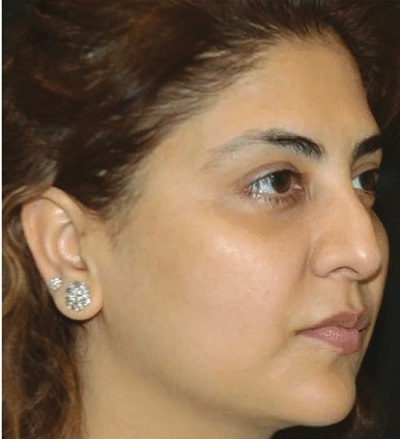 after eye brow lift treatment laser non surgical best dermatologists india ofy clinics before after