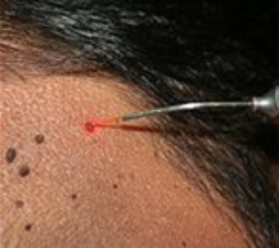 before mole removal treatment painless ofy skin clinics in surat chhindwara raipur nagpur bhopal india