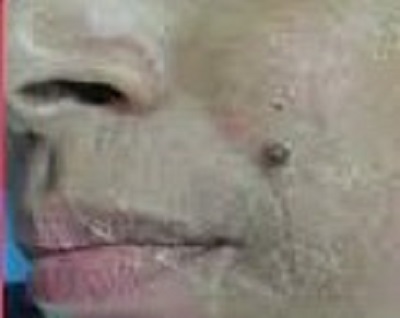 before mole removal treatment surgery painless ofy skin clinics in surat chhindwara raipur nagpur bhopal india