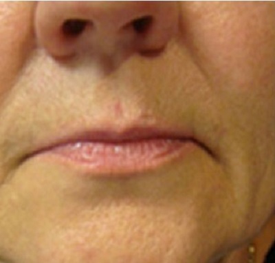before surgery lip augementation laser lip surgery best skin clinics in india indore surat nagpur bhopal raipur chhindwara