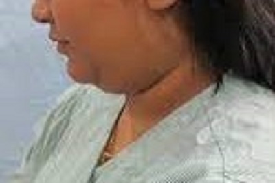 double chin reduction surgery before after ofy clinics bestdermatologists india nagpur chhindwara raipur bhopal indore best dermatologists