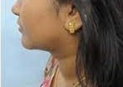 double chin reduction surgery before after ofy clinics bestdermatologists india nagpur chhindwara raipur bhopal indore best dermatologists
