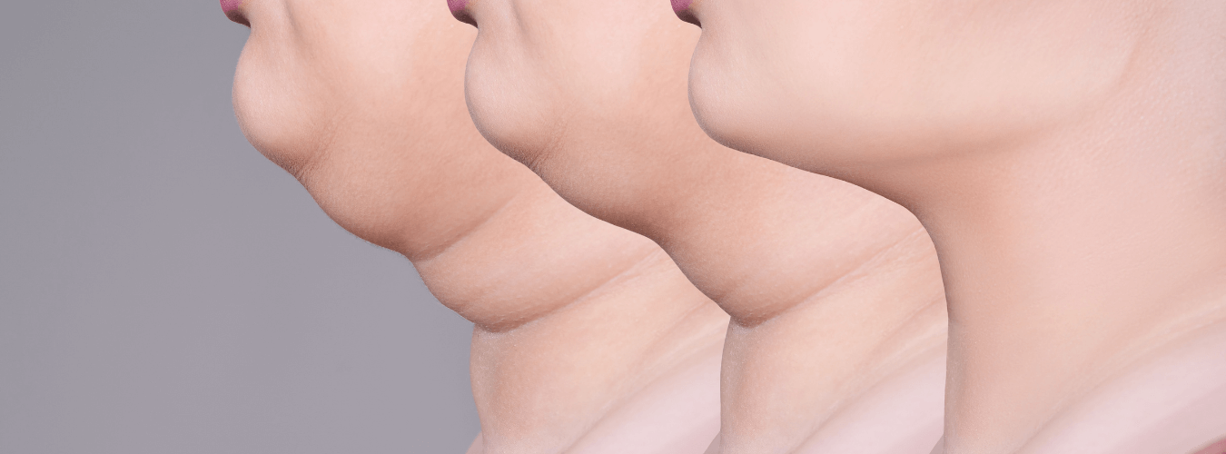 double chin reduction surgery before after ofy clinics bestdermatologists india nagpur chhindwara raipur bhopal indore