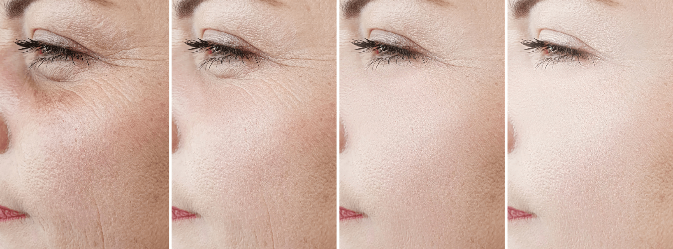 filler treatment wrinkle free collagen hyalaronic acid painless ofy skin clinics in surat chhindwara raipur nagpur bhopal india
