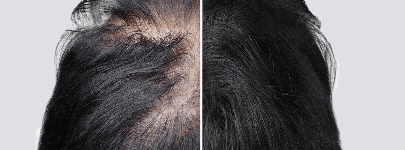 hair regrowth treatment laser hair growth hair fall chhindwara surat nagpur raipur indore bhopal ofy clinics best