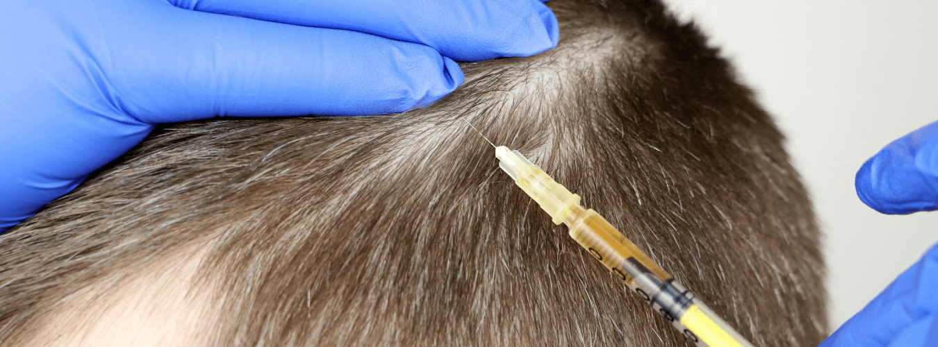 mesotherapy hair treatment laser hair growth hair fall chhindwara surat nagpur raipur indore bhopal ofy clinics best