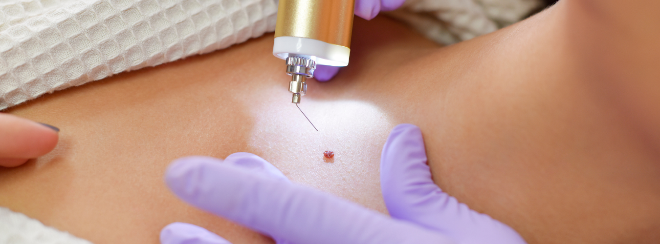 mole removal treatment painless ofy skin clinics in surat chhindwara raipur nagpur bhopal india