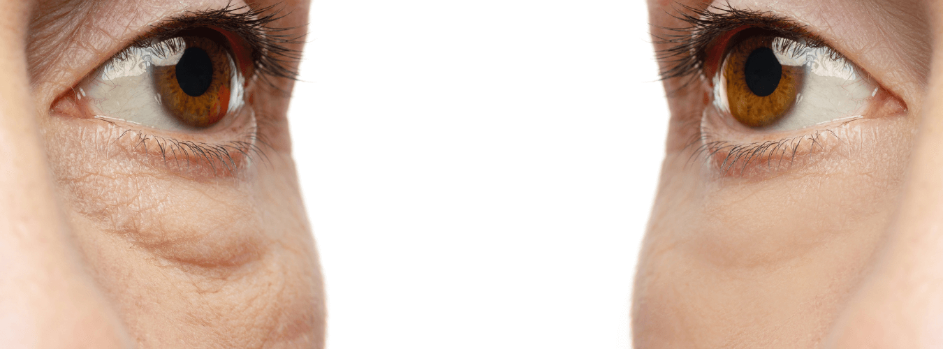 skin tightening treatment anti aging glow wrinkle free ofy clinics dermatologist in india
